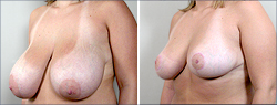 Breast Reduction Before and After Images