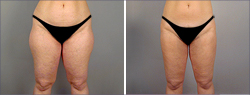 Liposuction Before and After Images