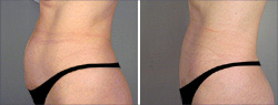 Tummy Tuck Before and After Images