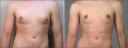 Male Breast Reduction New Jersey, Before and After, Patient 1