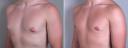 Male Breast Reduction New Jersey, Before and After, Patient 2