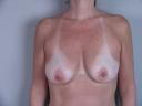 breast_enlargement_new_jersey_before_front.jpg