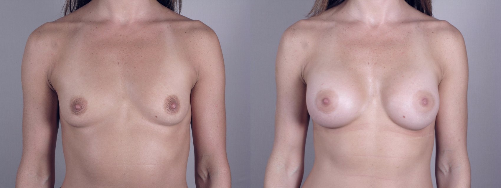 New Jersey Breast Augmentation Image