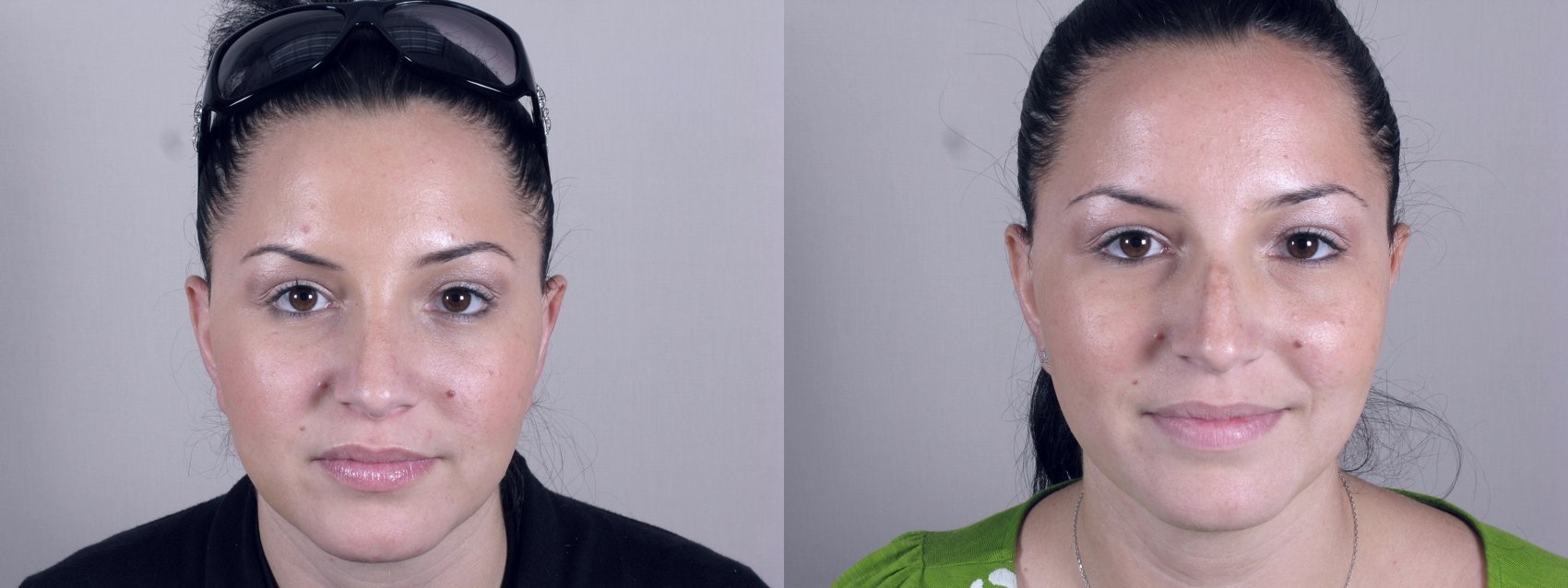 rhinoplasty-after-before-front.jpg