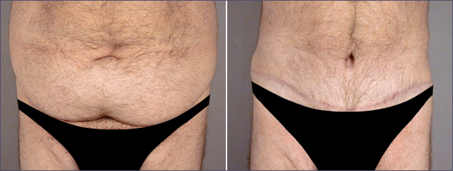 Male Liposuction Before and After Photo