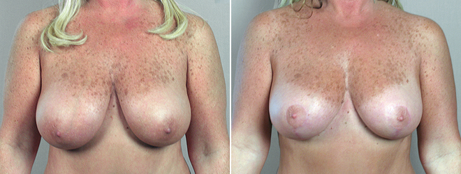 breast_reduction_16a.jpg