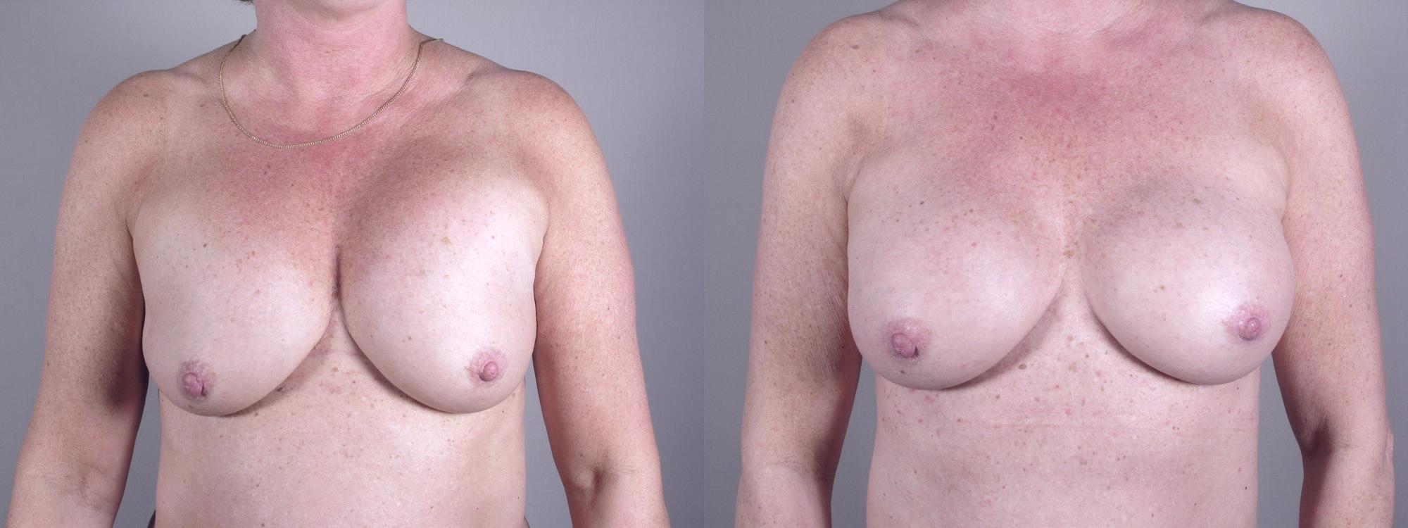 new_jersey_breast_augmentation.JPG