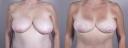 pc_front_breast_beforeafter.jpg
