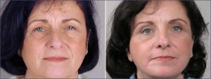 Face Lift New Jersey Image