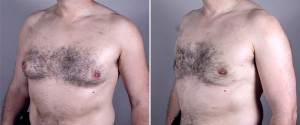 Male Breast Reduction New Jersey Image