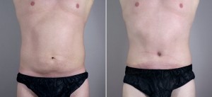 New Jersey Abdominoplasty for Men Image
