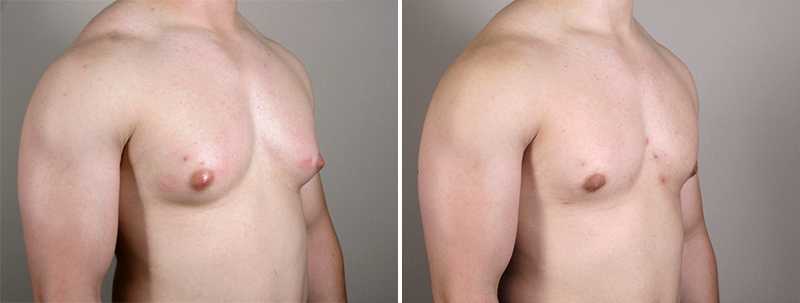 Male Breast Reduction New Jersey Image