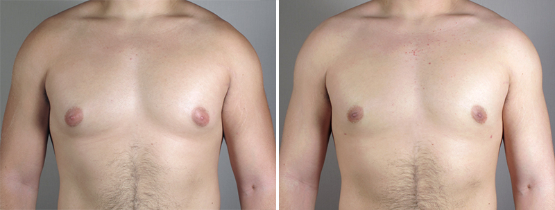 Breast Reduction for Men New Jersey