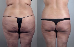 New Jersey Liposuction Photos