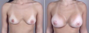 new jersey breast augmentation
