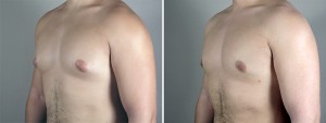 breast reduction for men new jersey