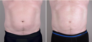 /men/male-breast-reduction-new-jersey/