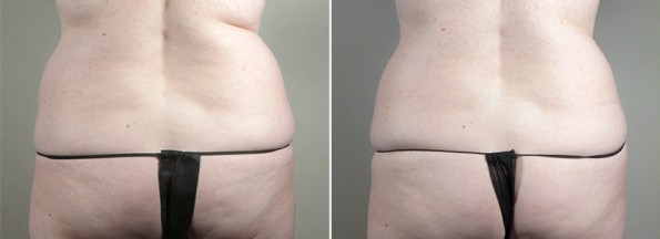 Coolsculpting New Jersey
