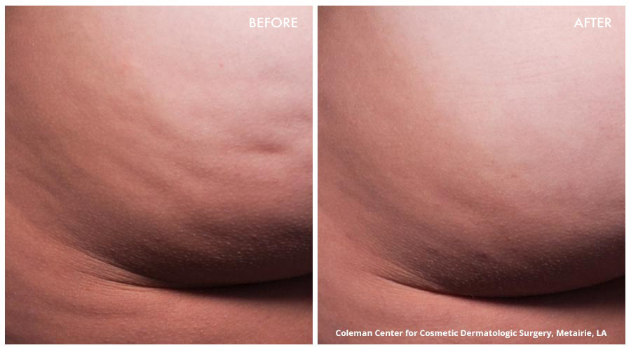 Cellfina Cellulite Reduction New Jersey Parker Center For Plastic Surgery