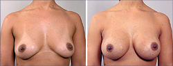 New Jersey breast surgery