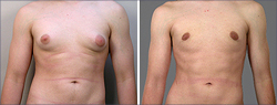 male breast reduction in NJ