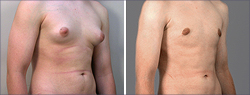 New Jersey Male breast reduction surgery
