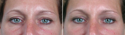 eyelid surgery in New Jersey
